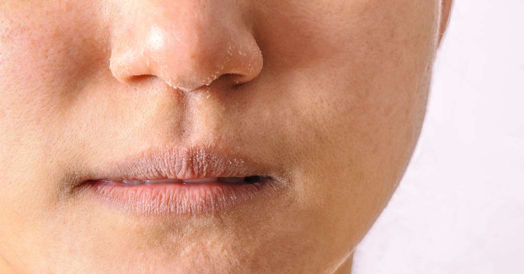 Dryness & Dehydration